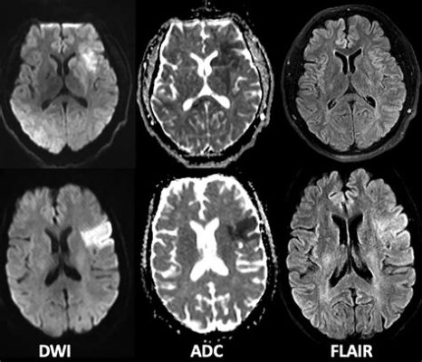 Will an MRI Show a Stroke: And Can It Also Predict the Weather?